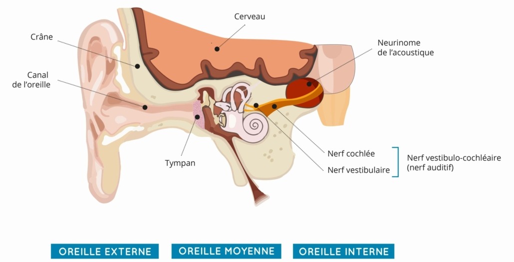 schéma neurinome de l’acoustique Audition Cornuau